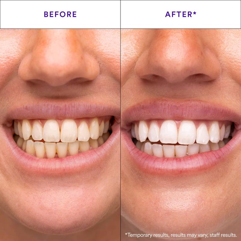 MySmile | Whitening Strips